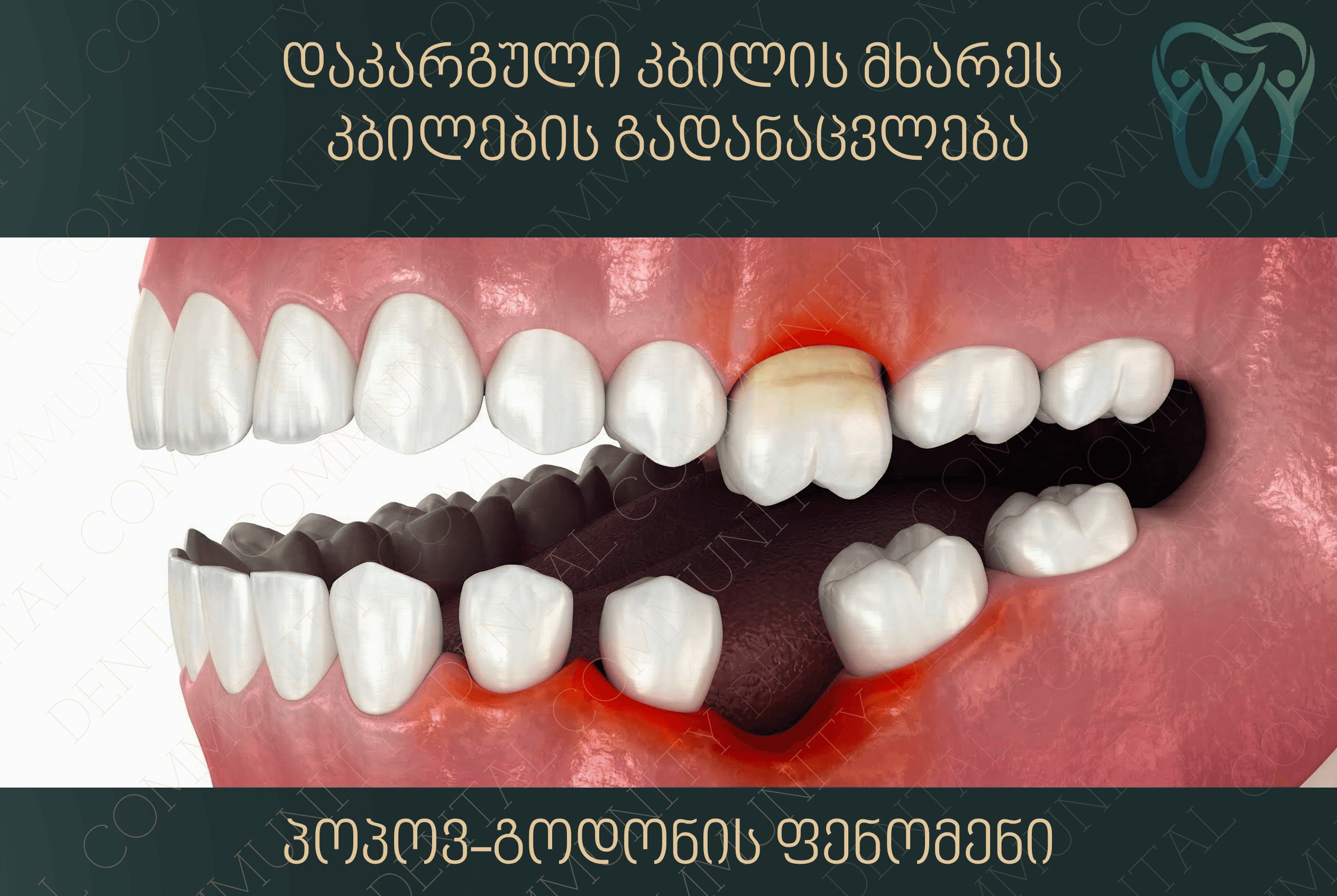 Dental Implant - 2