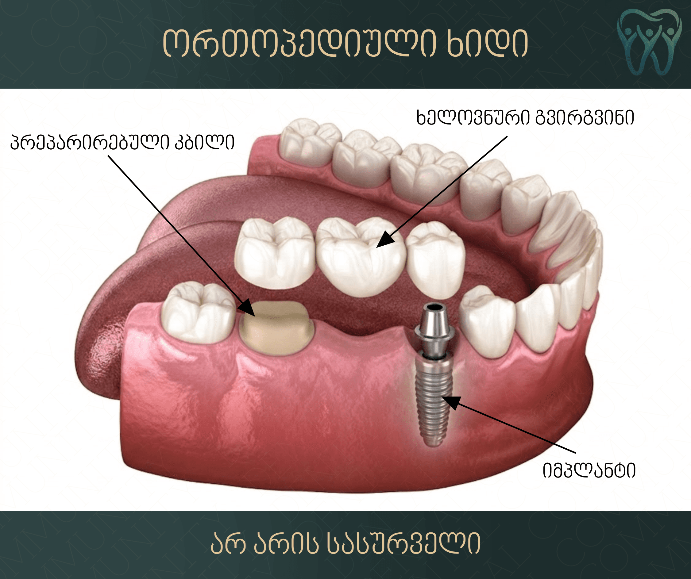 Dental Bridge - 2