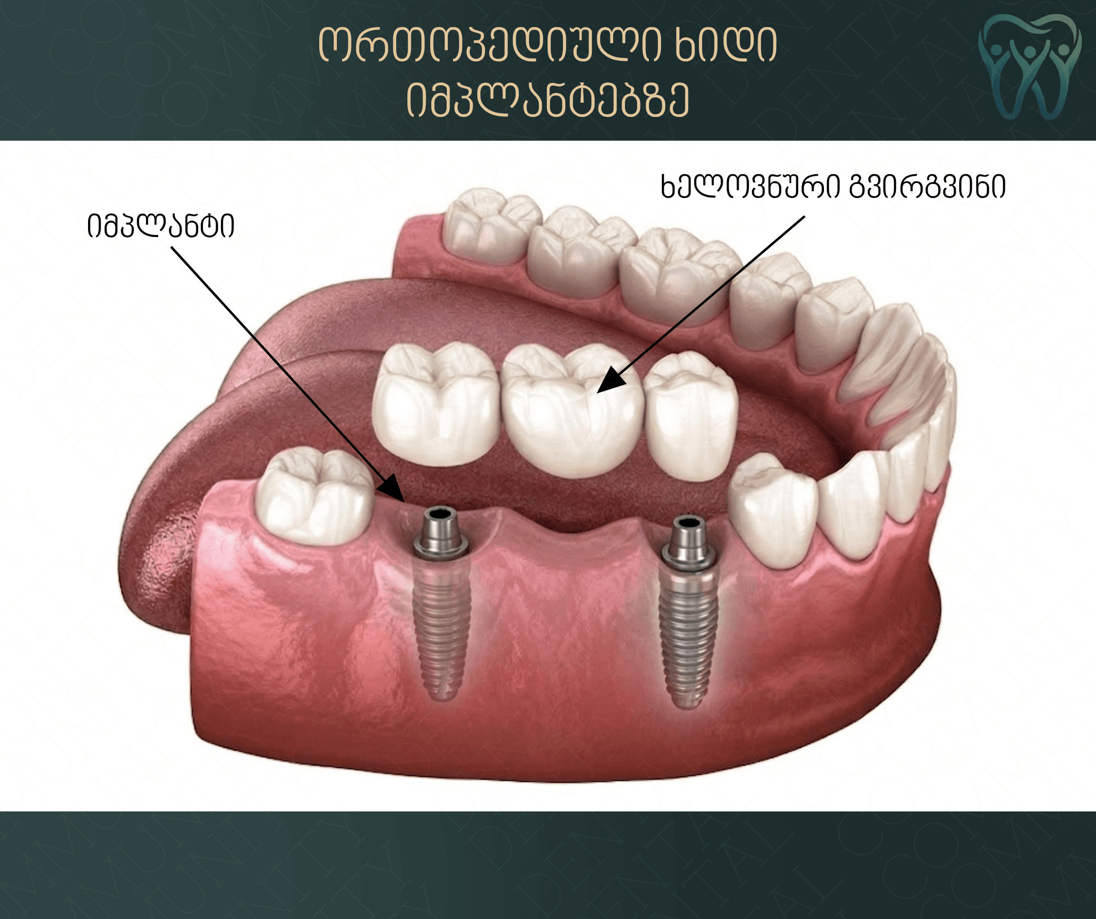 Dental Bridge - 3